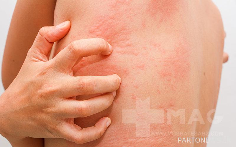 urticaria