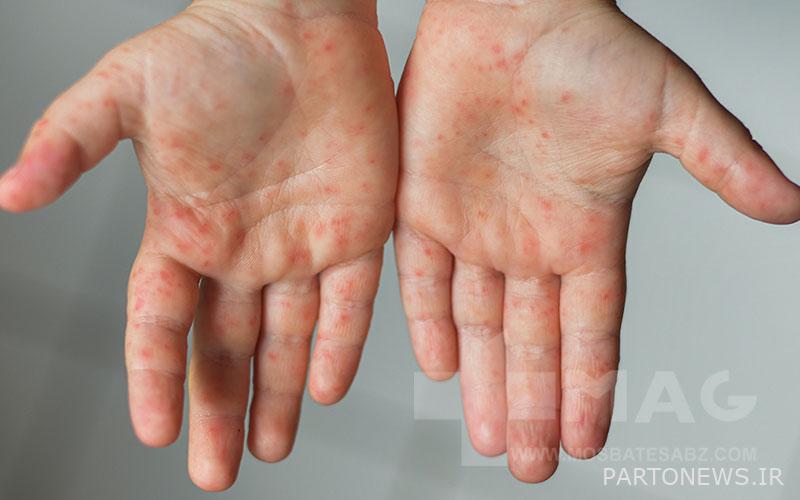 measles