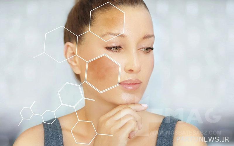 Melasma