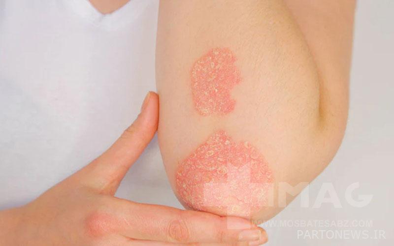 Psoriasis