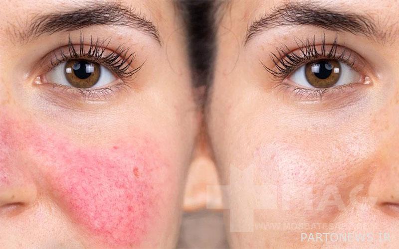 rosacea