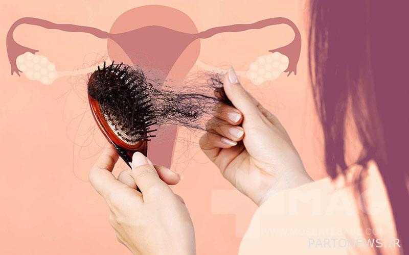 Polycystic ovary syndrome and hair loss