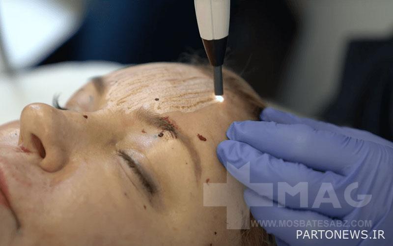 skin rejuvenation