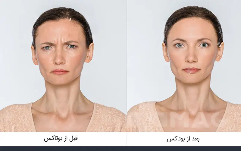 Before and after Botox