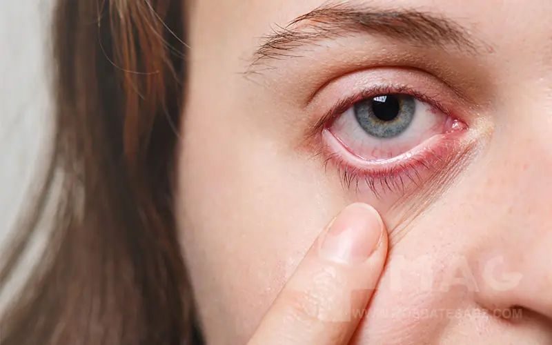 Side effects of eye cream