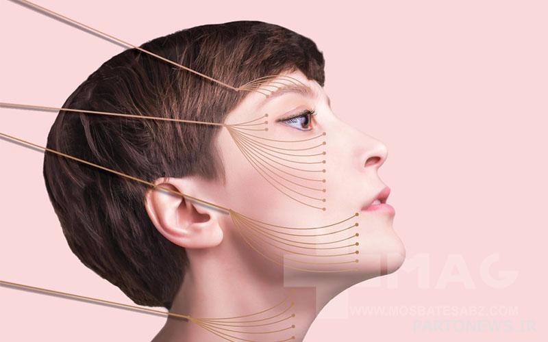 Face lift with threads