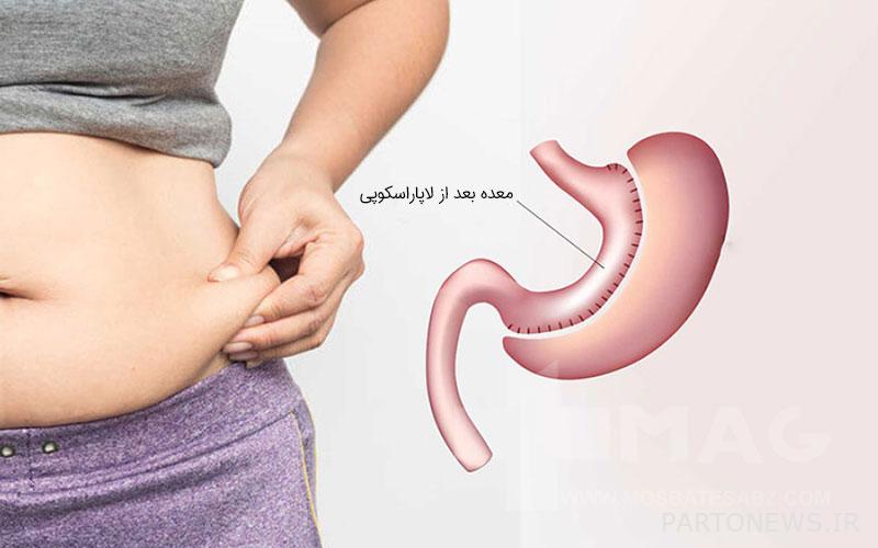 Stomach after laparoscopy