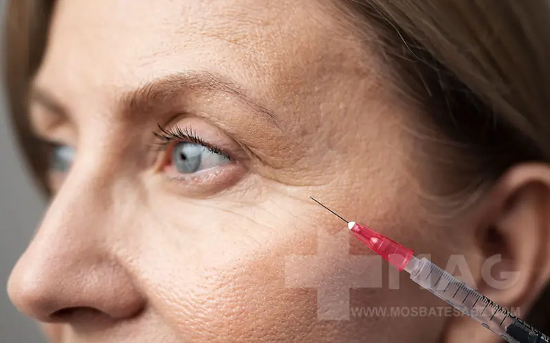 Botox at the age of 50