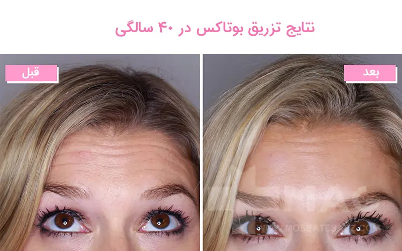 Botox results at 40 years old