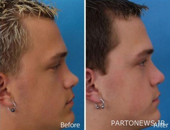 Nose operation 3