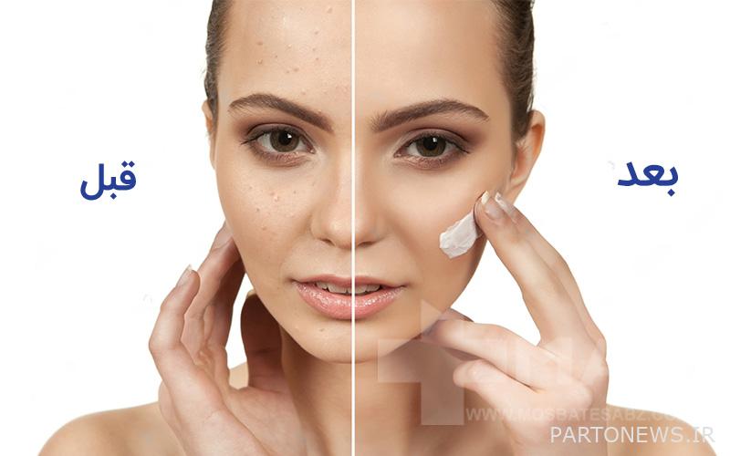 Before and after using acne cream