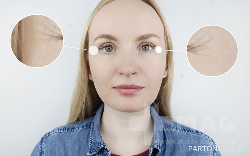 Increasing trend in the eye area