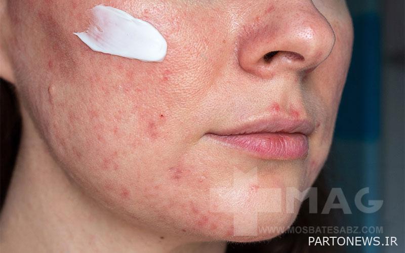 Anti-pimple cream to get rid of pimples quickly