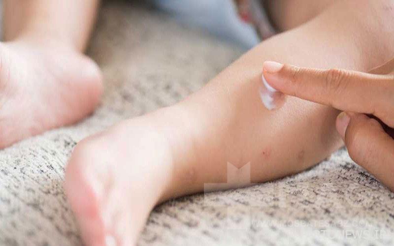 Calamine ointment for insect bites