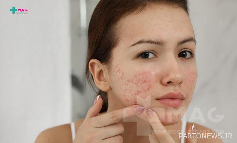 Do pimples appear overnight? 6 misconceptions that you should stop