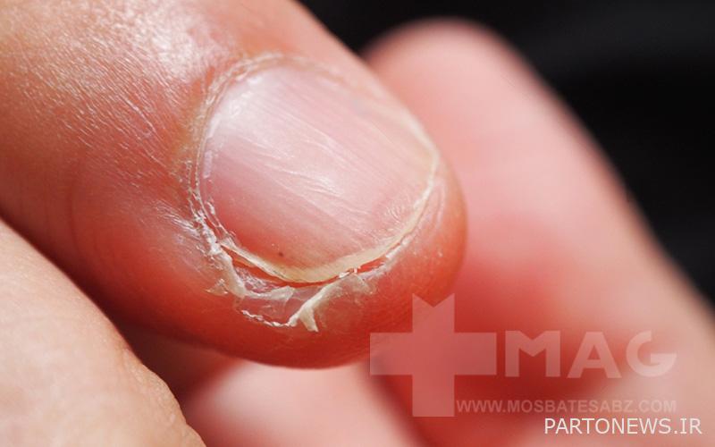 Brittle nails are signs of biotin deficiency