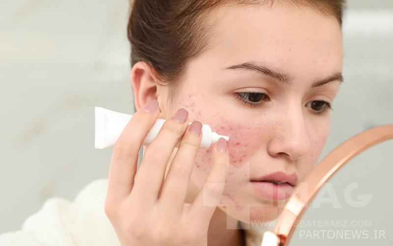 Acne treatment with aknomys