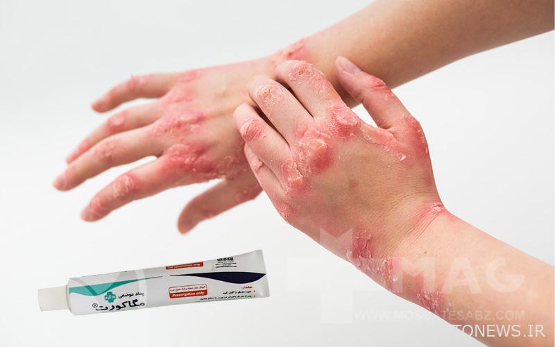 Megacort for psoriasis