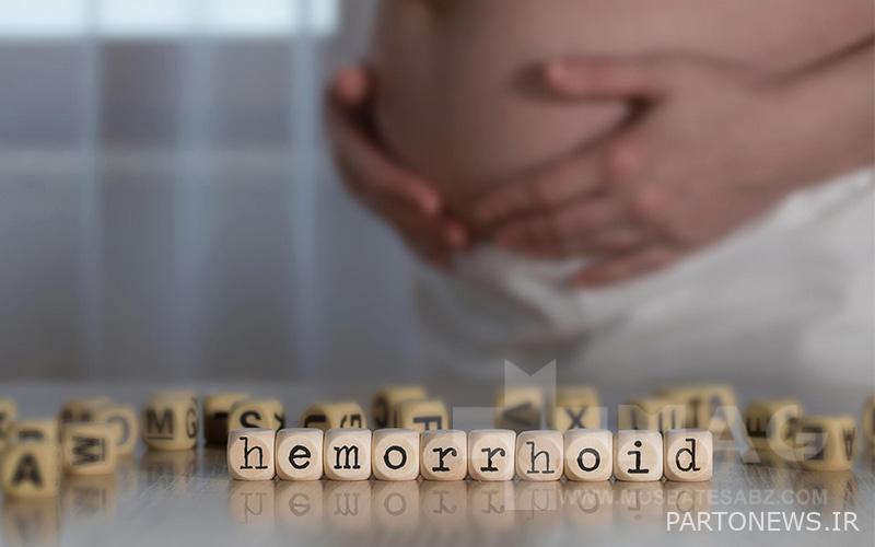 Hemorrhoids in women