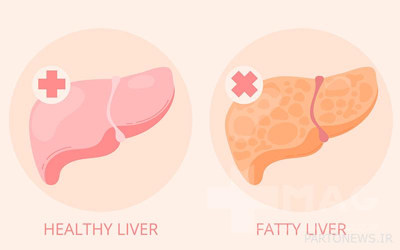 Healthy liver and fatty liver