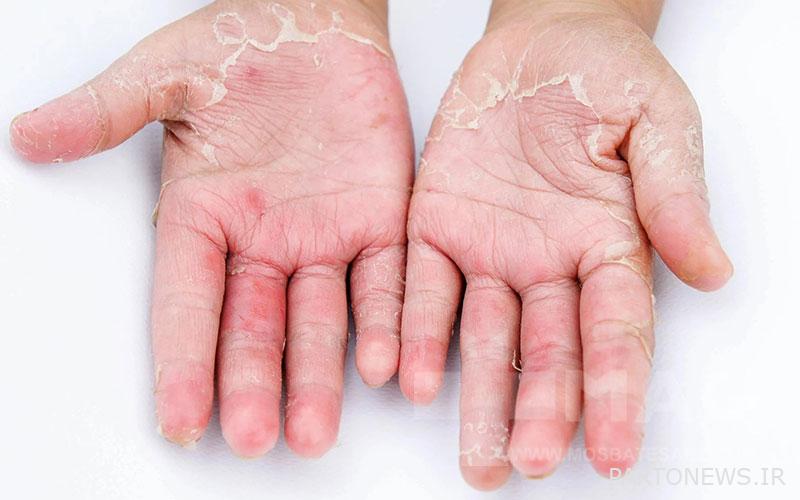 Peeling skin of the palm