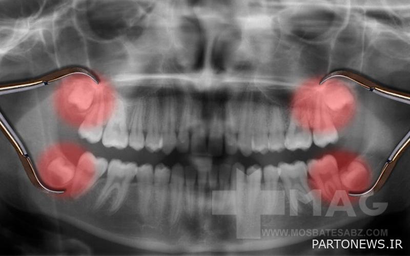 Photo of wisdom teeth