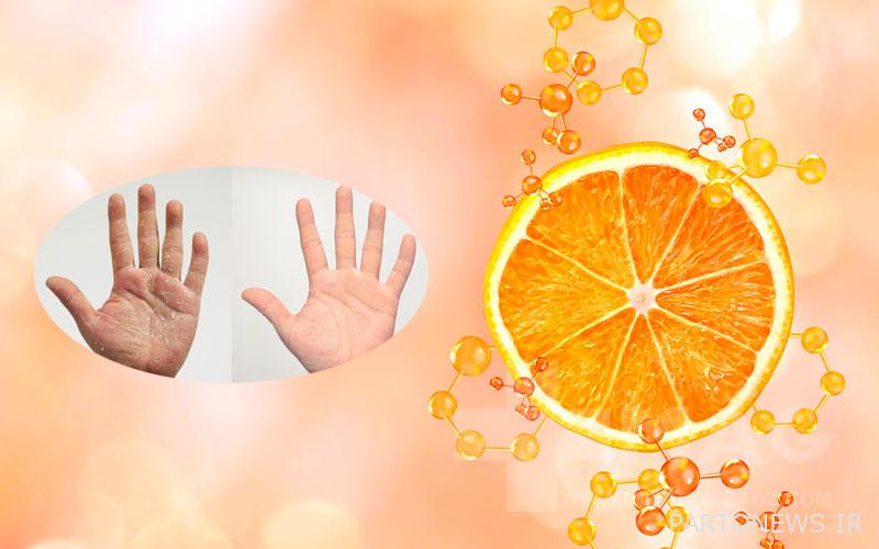 Vitamin C deficiency and its effect on peeling of the palm